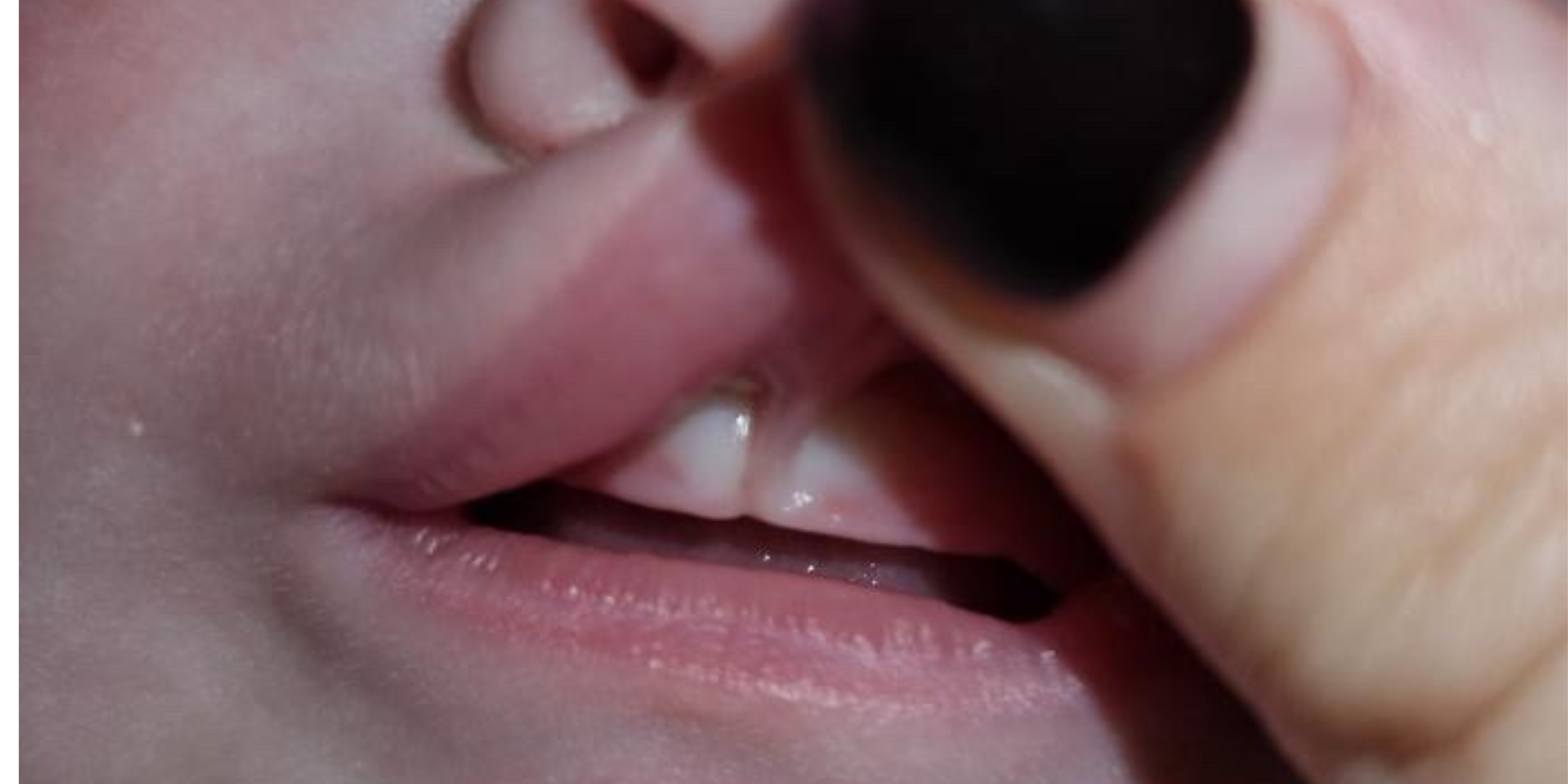 What are Epstein Pearls?